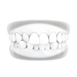 Smile Better with Invisalign Lite by T32 Dental | Singapore Dental Clinic 19